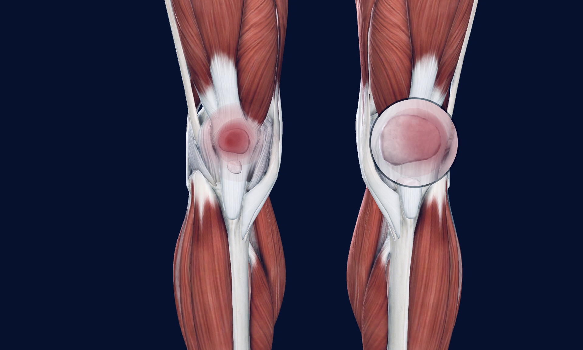 Patellofemoral Syndrome Osteo Health Osteopath Clinic In Calgary