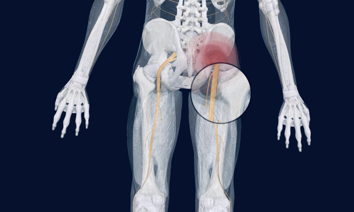 https://www.osteohealthcalgary.com/wp-content/uploads/2020/05/sciatica-e1605327304433.jpg